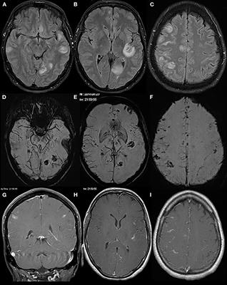 A Fulminant Case of Demyelinating Encephalitis With Extensive Cortical Involvement Associated With Anti-MOG Antibodies